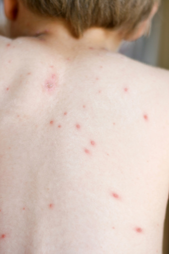 Chickenpox on a little boy's back