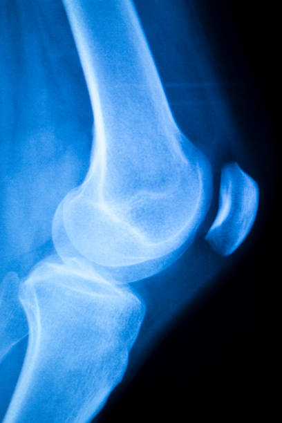 genou joint ménisque x-ray test scanner - ménisque photos et images de collection