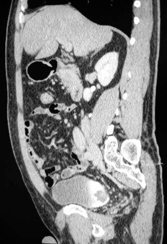 carcinoma of urinary bladder in sagittal CT image.