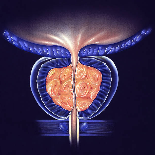 illustrations, cliparts, dessins animés et icônes de prostate-(bph) tumeur prostatic hyperplasie, étape n ° 3 - prostate gland