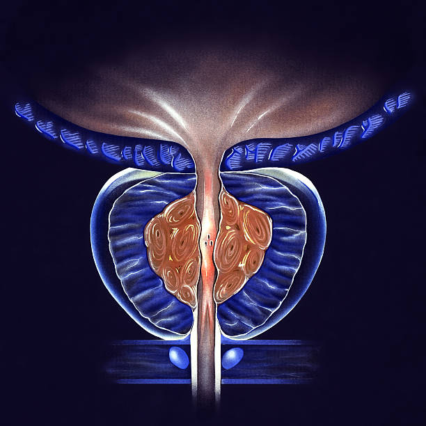 illustrations, cliparts, dessins animés et icônes de prostate-(bph) tumeur prostatic hyperplasie, scène 2 - prostate gland