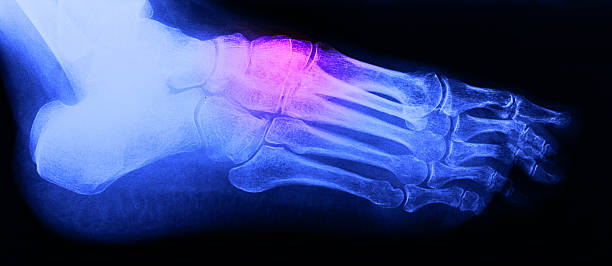 istock Right foot ankle Xray 504891562