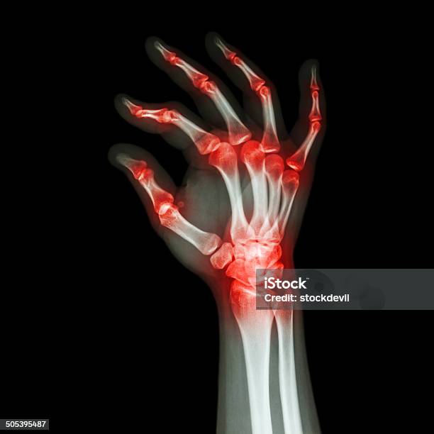 Rheumatoid Arthritis Gouty Arthritis Stock Photo - Download Image Now - Adult, Adults Only, Anatomy