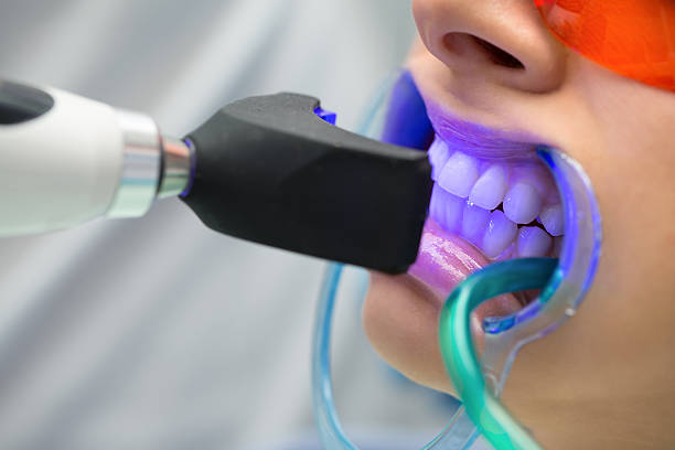 dientes llenado de lámpara ultravioleta - blanqueamiento dental fotografías e imágenes de stock