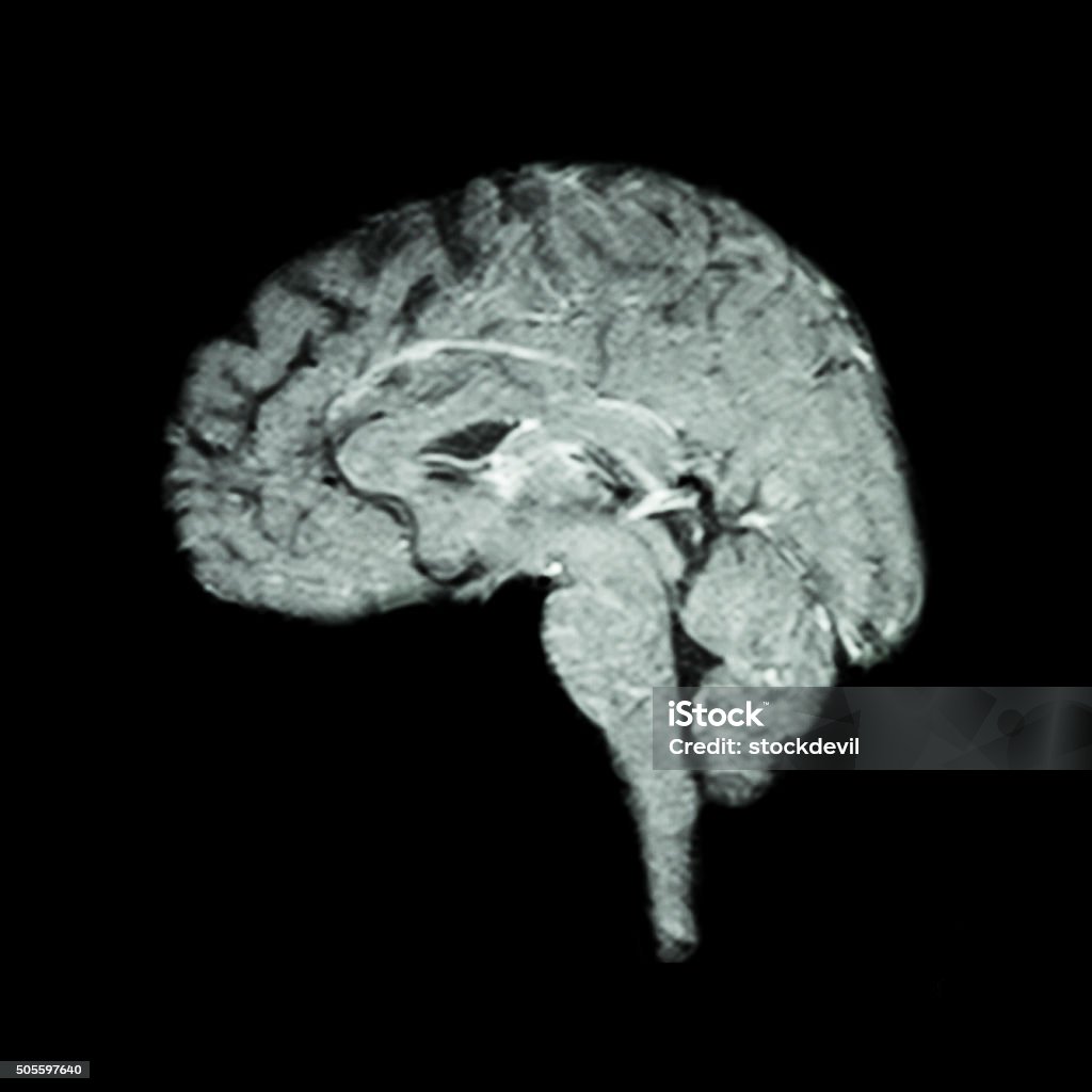 Magnetic Resonance Imaging ( MRI ) of brain Magnetic Resonance Imaging ( MRI ) of brain  ( Medical , science and healthcare concept ) Cerebrum Stock Photo