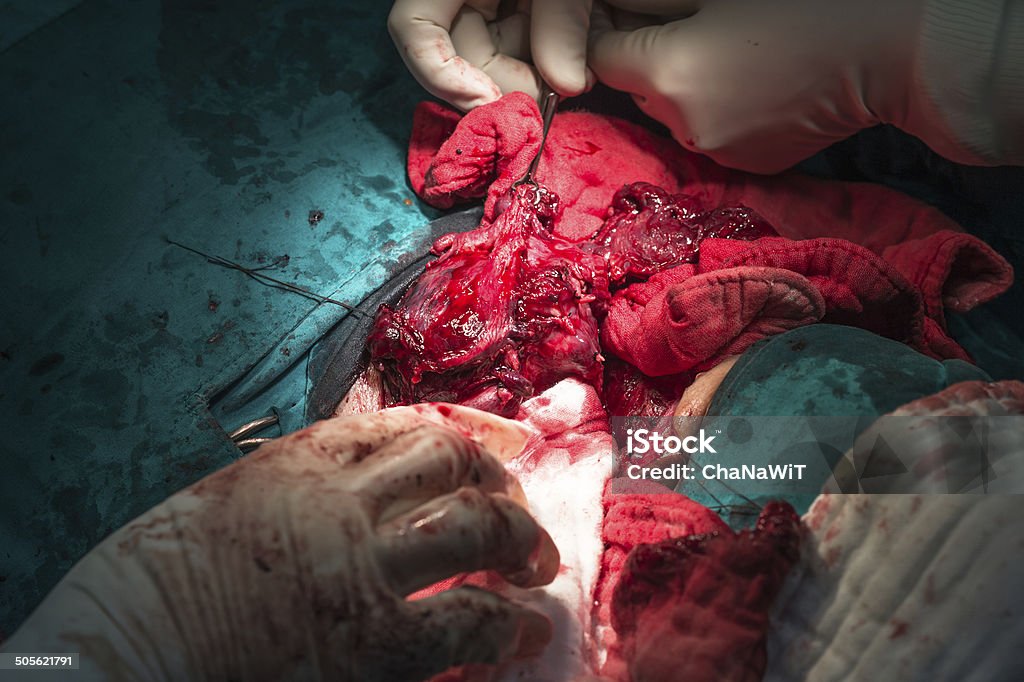 total thyroidectomy Adenocarcinoma Stock Photo