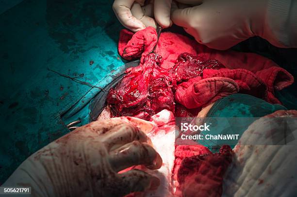 Total Thyroidectomy Stock Photo - Download Image Now - Adenocarcinoma, Anatomy, Blood