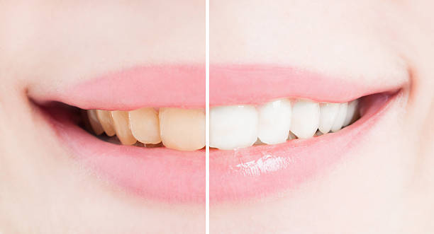 istock Whiten teeth after bleaching or whitening 505776758