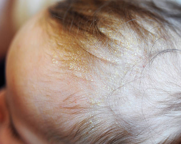 istock Cradle Cap or Infantile Seborrheic Dermatitis 505846220