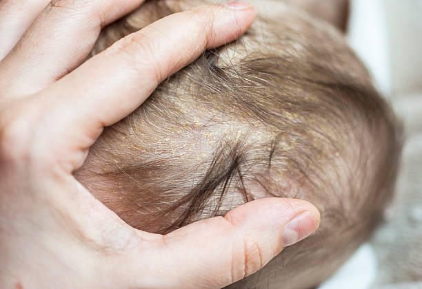istock Cradle Cap or Infantile Seborrheic Dermatitis 505865422
