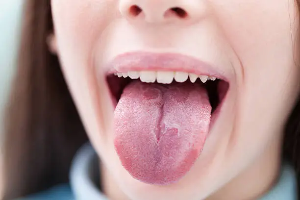 A little girl with a serious sore throat shows her geographic tongue.