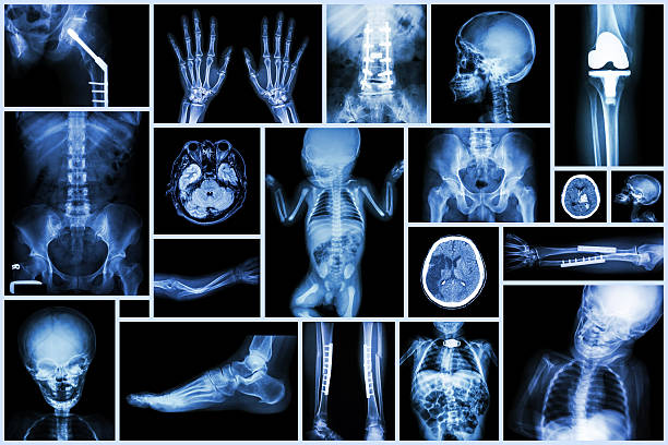 컬레션 x-레이 여러장 성인 및 아동 기관 & 정형외과 수술 - human lung x ray image x ray human spine 뉴스 사진 이미지