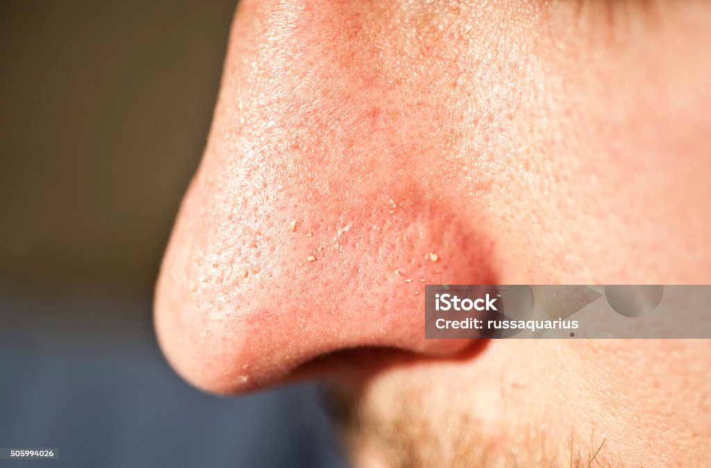 Facial Skin Closeup; Squeezed out Whiteheads Close-up of human facial pores and squeezed out whiteheads Sebum Stock Photo