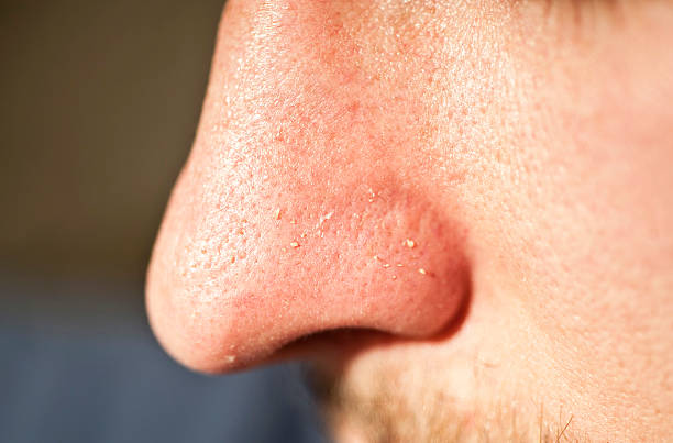 Facial Skin Closeup; Squeezed out Whiteheads stock photo