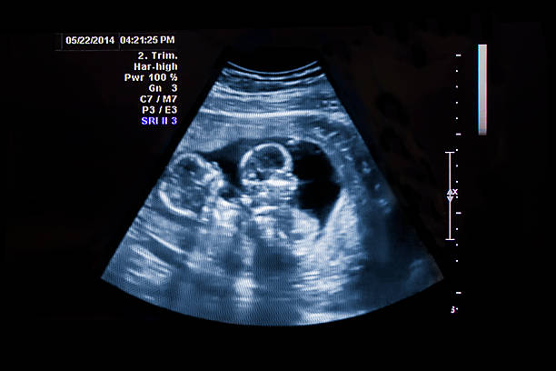 twins ultrasound - eeneiige tweeling stockfoto's en -beelden