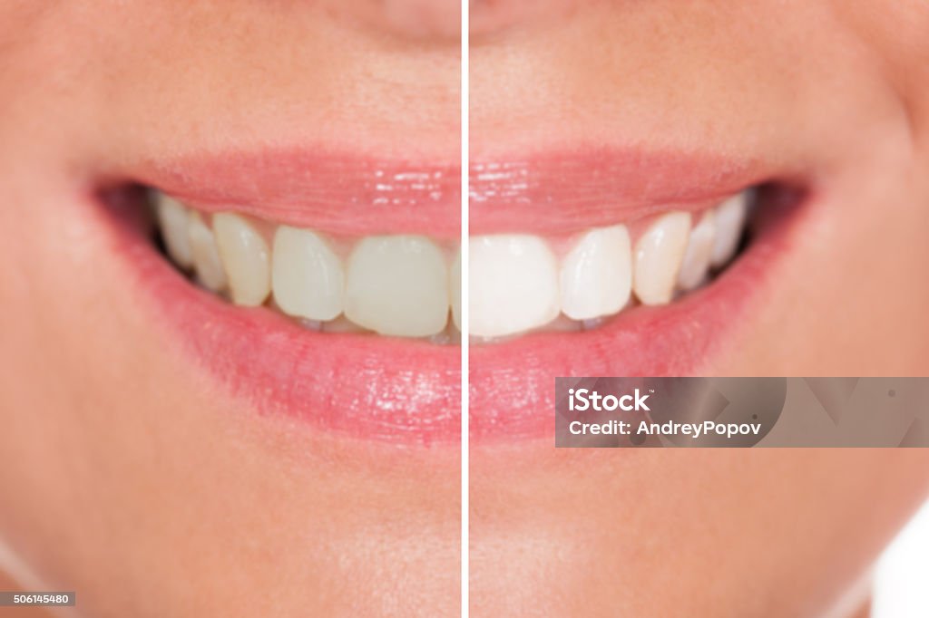 Close-up Of Woman Teeth Close-up Of Woman Teeth Before And After Whitening In Front Of Stock Photo