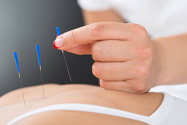 istock Therapist Putting Acupuncture Needle On Woman's Back 506160216