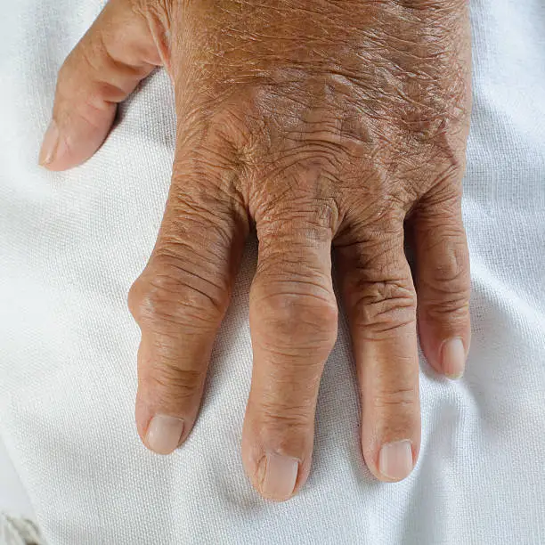 Fingers of patients with gout.