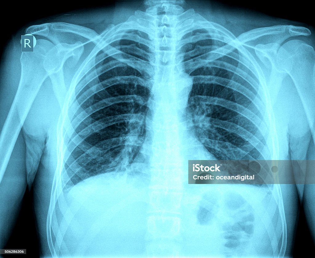 Chest X-ray image Asthmatic Stock Photo