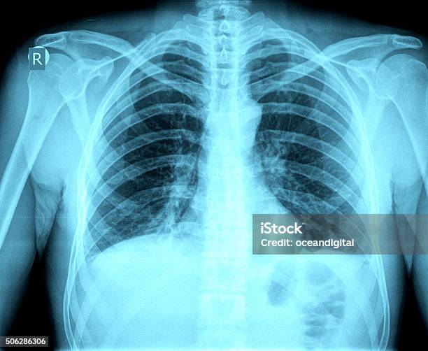 Chest Xray Image Stock Photo - Download Image Now - Asthmatic, Anatomy, Asthma Inhaler