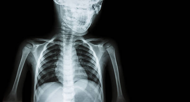 filme de raios-x do corpo de criança - x ray x ray image shoulder human arm imagens e fotografias de stock