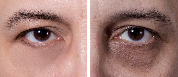 Sleep Deprivation Before And After