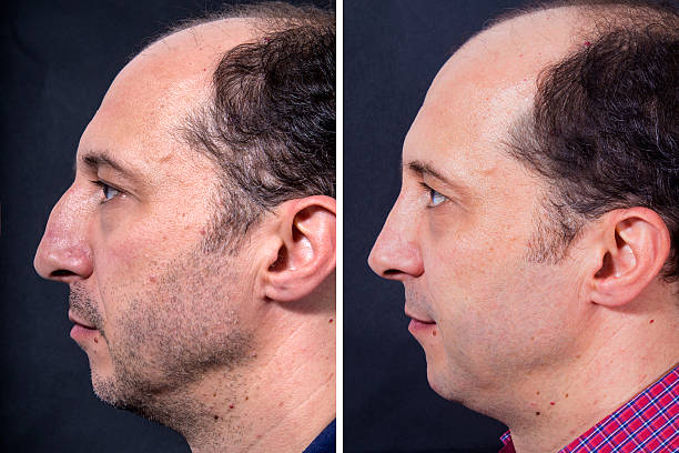 istock Plastic surgery of the nose - situation BEFORE and AFTER 506340594