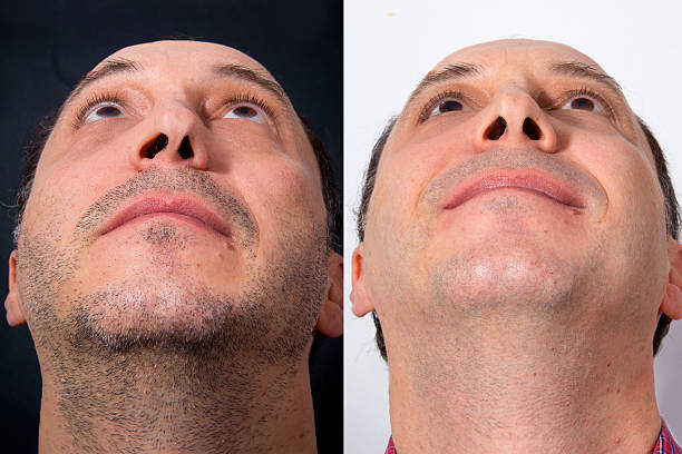 istock Plastic correctional surgery of the nose - BEFORE and AFTER 506340950