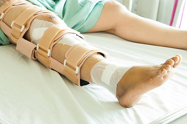 woman wearing a leg brace, Broken leg stock photo