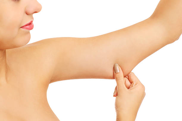 istock Loose skin on arms 506588270
