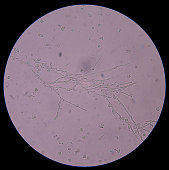 branching-angehende-hefe-zellen-mit-pseudohyphae-in-urin.jpg?b=1&s=170x170&k=20&c=oPtKxvBBU8u66LbloC9tFffaDs7nndlfnWv8o6WOosk=
