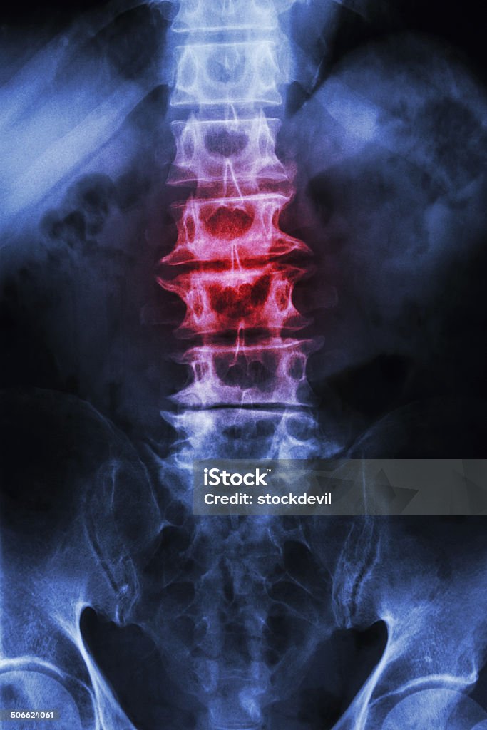 Spondylosis and Scoliosis "Spondylosis and Scoliosis"  film x-ray L-S spine (lumbar-sacrum) of old aged patient Abdomen Stock Photo