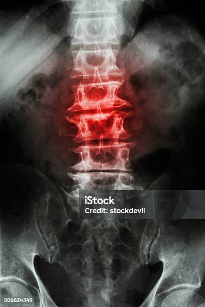 Spondylosis Y Escoliosis Foto de stock y más banco de imágenes de Deterioro - Deterioro, Articulación, Cintura