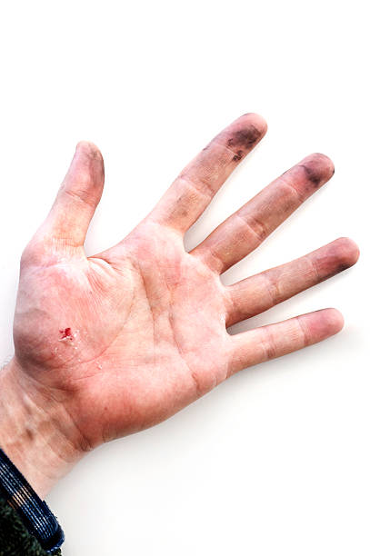 istock Hurt palm of the hand 506828046