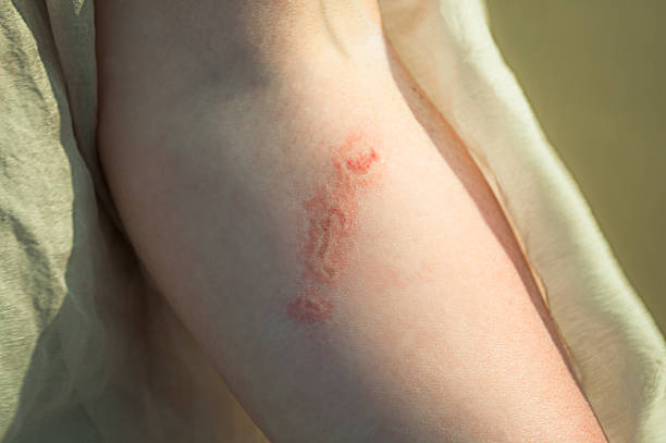 Injury from a burn jellyfish on a female hand Injury from the bite of jellyfish on a woman hand closeup stinging photos stock pictures, royalty-free photos & images