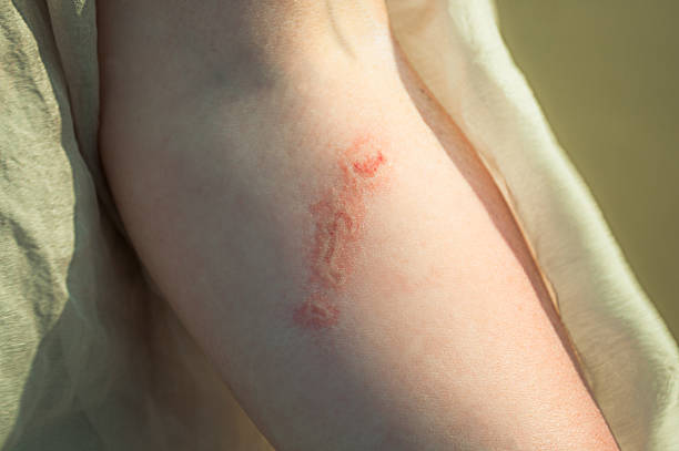 Injury from a burn jellyfish on a female hand Injury from the bite of jellyfish on a woman hand closeup stinging stock pictures, royalty-free photos & images