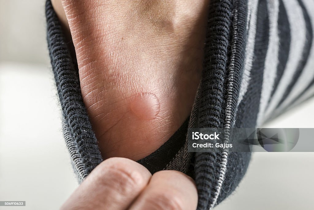 Man with a blister on his heel Man with a fluid blister on his heel from the rubbing and friction caused by ill fitting shoes pulling down his sock to display it to the camera. Blister Stock Photo