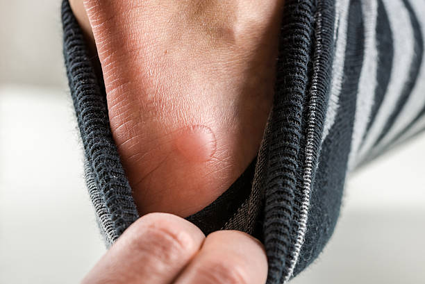 Man with a blister on his heel stock photo