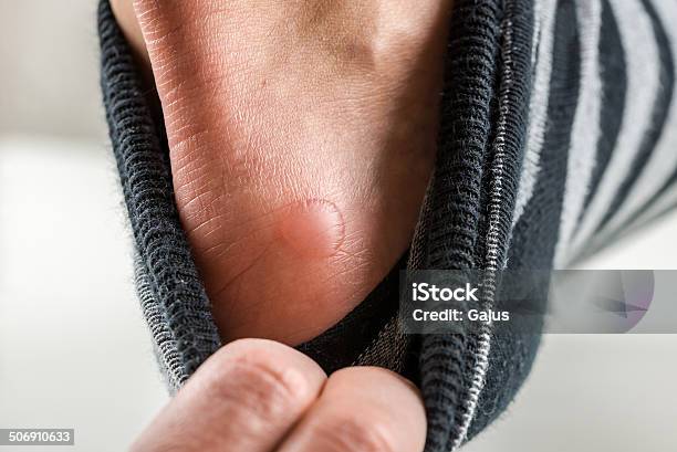 Man With A Blister On His Heel Stock Photo - Download Image Now - Blister, Human Foot, Problems