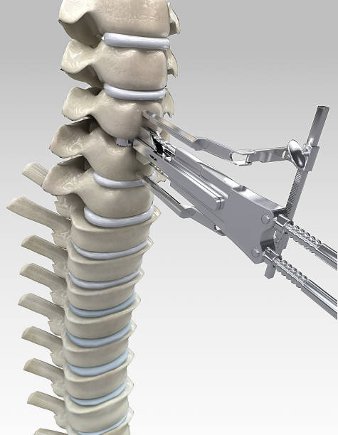 3 d colonna vertebrale illustrazione di un intervento chirurgico - human spine chiropractor three dimensional shape healthcare and medicine foto e immagini stock