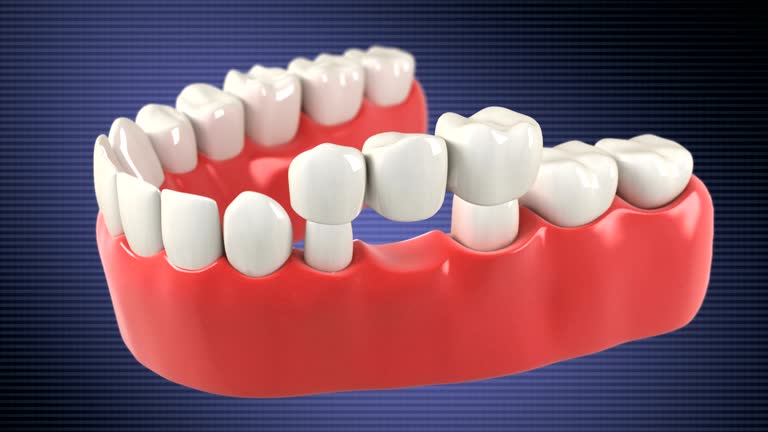 Installation process of Tooth Bridge. HD