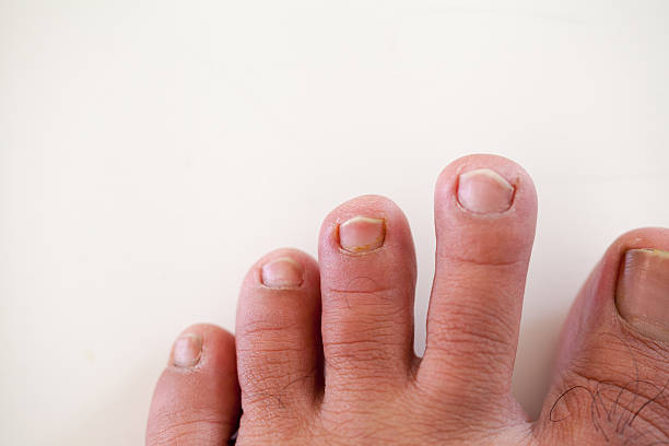 Toenail Pus Stock Photos, Pictures & Royalty-Free Images - iStock