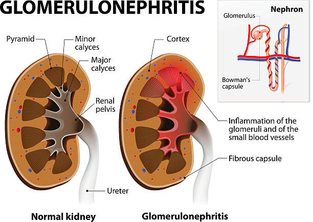 illustrazioni stock, clip art, cartoni animati e icone di tendenza di glomerulonefrite o glomerulare nefrite. rene malattia - glomerulus