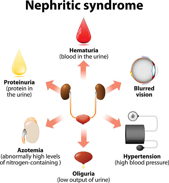 신염성 증후군 - glomerulus stock illustrations