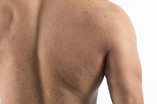 잡티 수컷 등근육 - acne back rear view men 뉴스 사진 이미지
