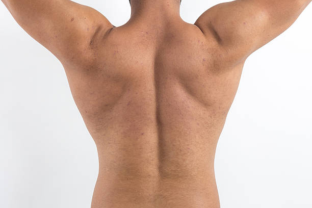 뛰어난 근육 쥐젖 대한 - acne back rear view men 뉴스 사진 이미지