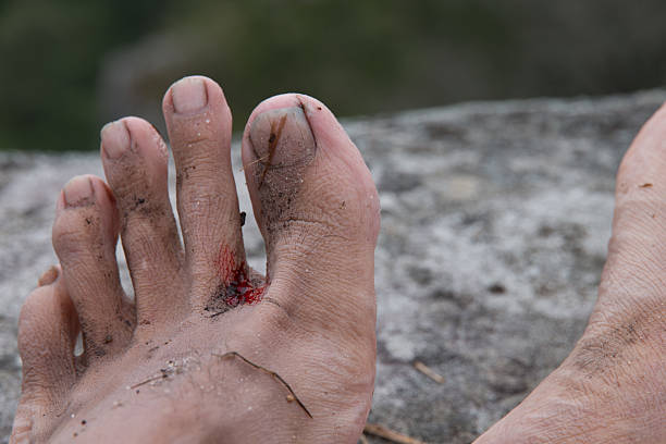 istock Foot ulcers with a blood. 507513248