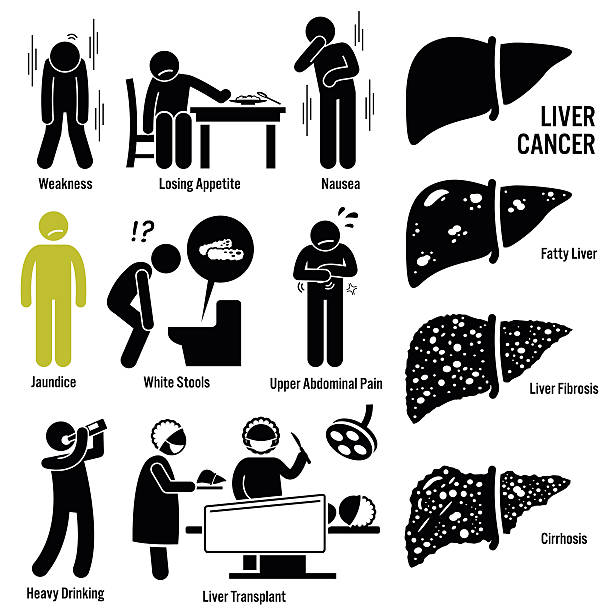 Liver Cancer Symptoms Transplant Illustrations Illustrations showing liver cancer symptoms, risk factors, and liver transplantation. It also show the process stages of how a liver eventually become cancer with fatty liver, fibrosis, and cirrhosis.  cancer illness illustrations stock illustrations