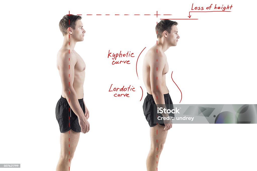 Man with impaired posture position defect scoliosis and ideal bearing Man with impaired posture position defect scoliosis and ideal bearing. Bad Posture Stock Photo