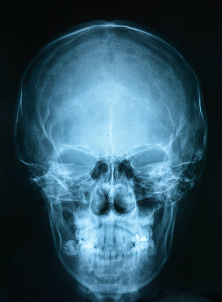 istock X-ray picture of the skull 507650085